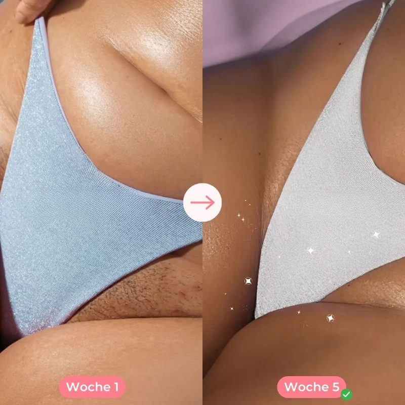 Ylvis IPL™ - Haarentferner