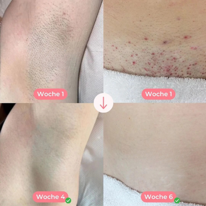 Ylvis IPL™ - Haarentferner