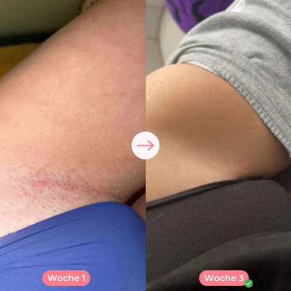 Ylvis IPL™ - Haarentferner