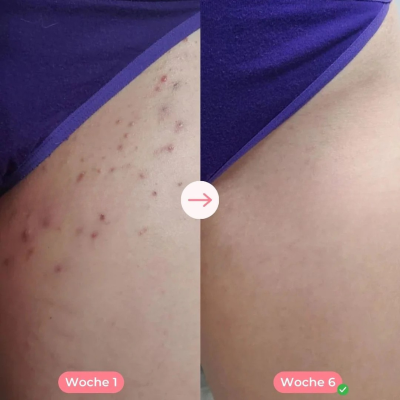 Ylvis IPL™ - Haarentferner